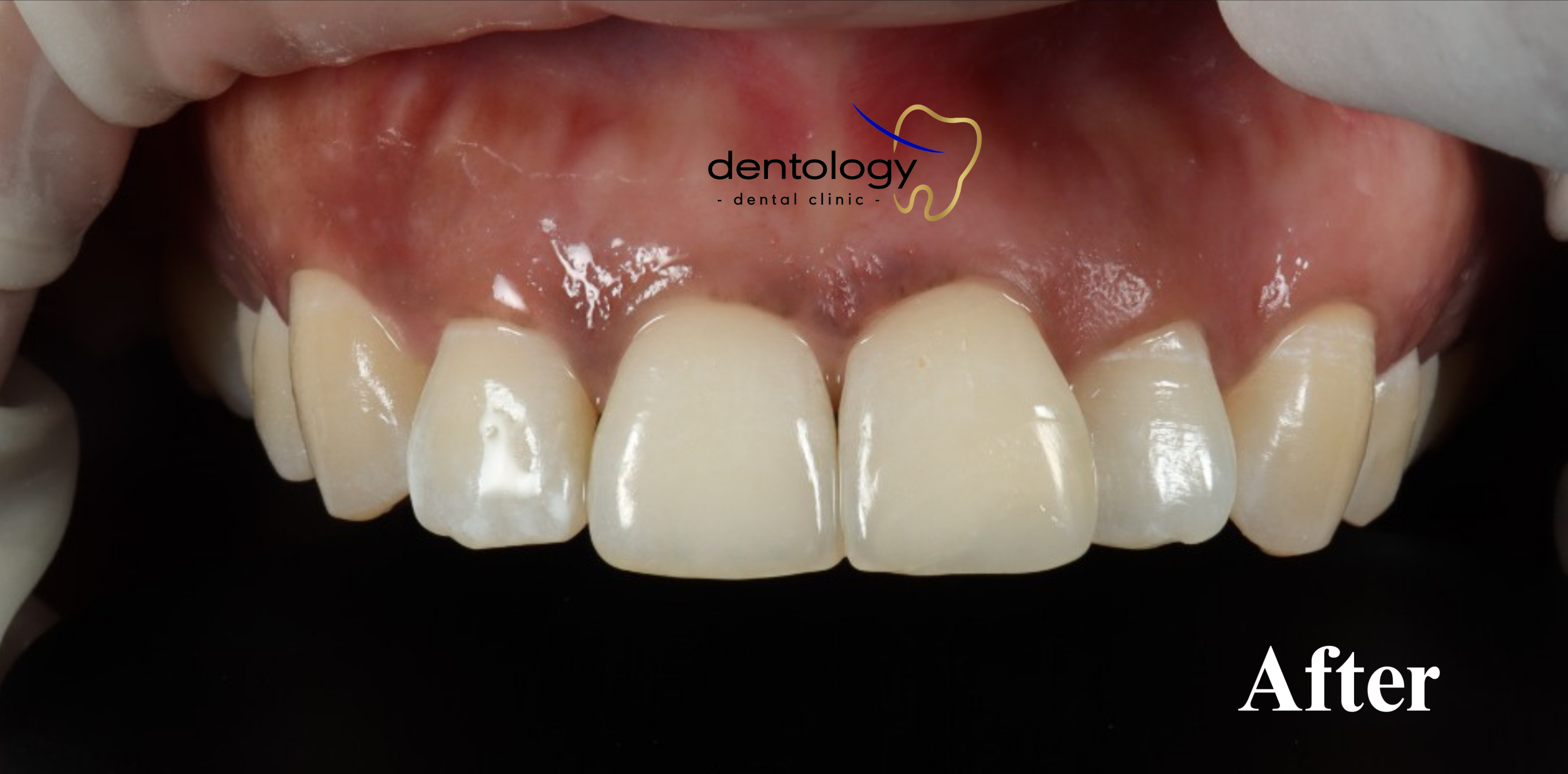 Endodontic dokter gigi denpasar