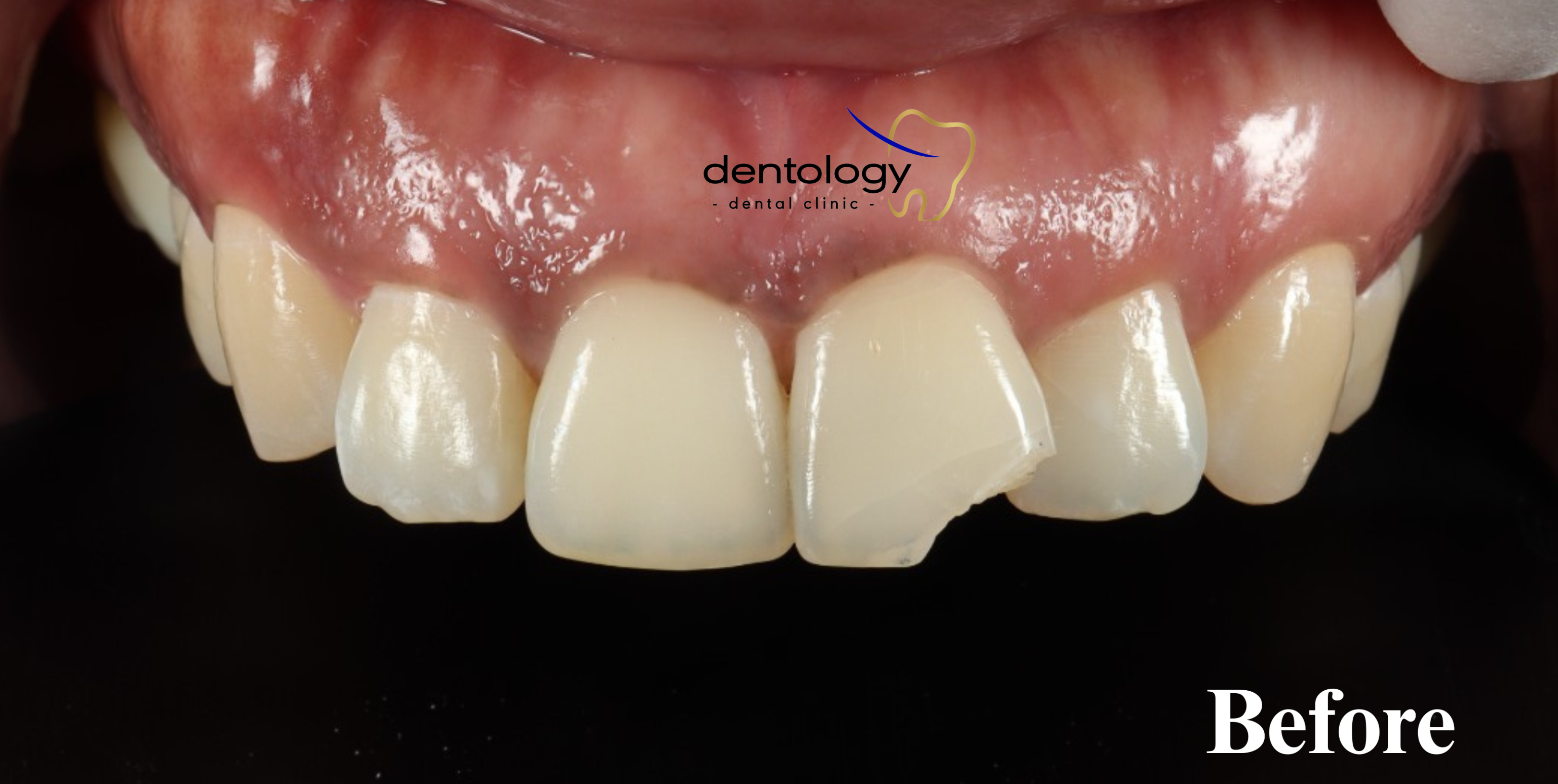 Endodontic dokter gigi denpasar